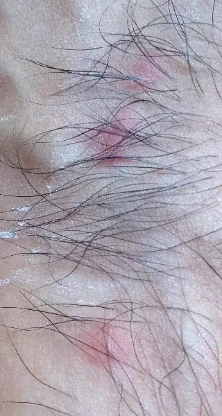 Flea bites on foot after 3 days