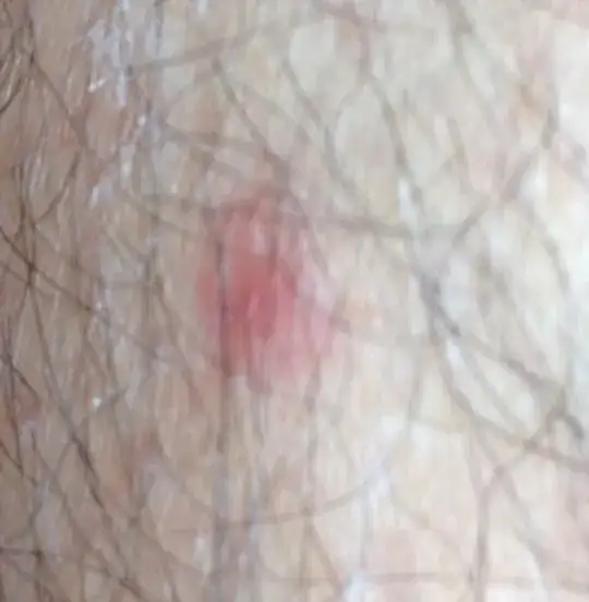 Flea bites on leg after 3 days