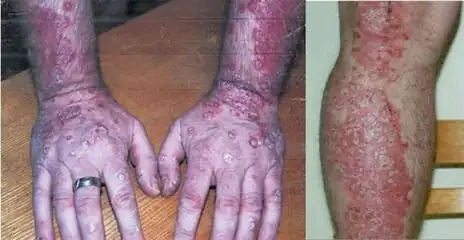 Individual with both psoriasis and HCL before receiving pentostatin