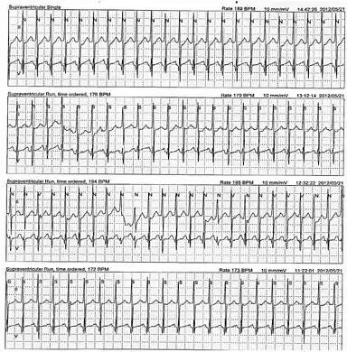 This Holter monitor strip of a 5-year-old showing atrial tachycardia. This person was eventually diagnosed with tachycardia-induced cardiomyopathy.