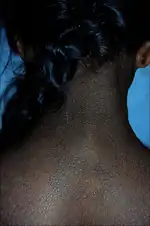 AN in ovarian cancer