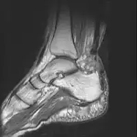 Achilles tendon rupture