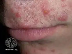 Acne with pustules