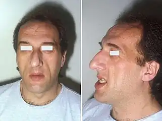 Mandibular overgrowth leads to prognathism, maxillary widening, teeth spacing and malocclusion