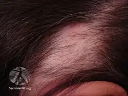 Alopecia areata