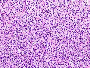 Histopathological image of anaplastic oligodendroglioma in cerebrum. Hematoxylin & eosin stain.
