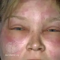 Angioedema