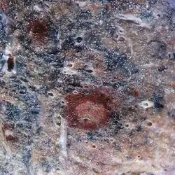 Angioinvasive aspergillosis demonstrating the gross pathology equivalent of the CT ground glass halo