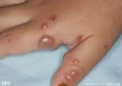 Bites from ants