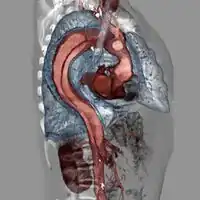 Aortic dissection
