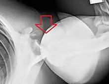Axillary view of the left shoulder showing a posterior dislocation
