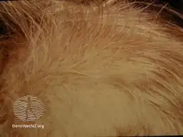 Beaded hair or monilethrix