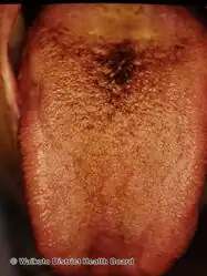 Black hairy tongue