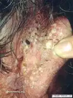 Chloracne/Blackheads and cysts