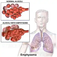 A diagram comparing normal alveoli to those with emphysema