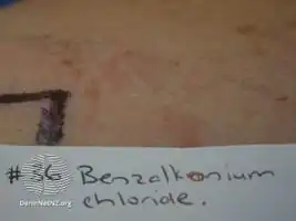 Borderline patch test reaction to benzalkonium chloride