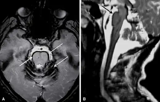 Brain MRI of a individual with superficial siderosis