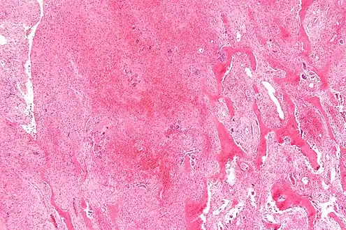 Micrograph of a brown tumor (left of image). H&amp;E stain.