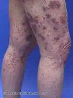 Bullous pemphigoid induced by pembrolizumab