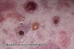 Bullous pemphigoid induced by pembrolizumab