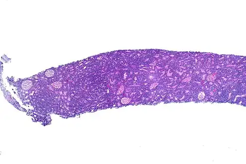 Burkitt lymphoma in a kidney biopsy