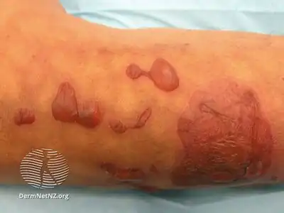 Burns from hot water bottle