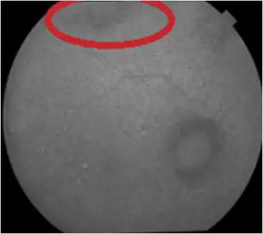 Hyperautofluorescence and hypoautofluorescence granular patterns in posterior pole