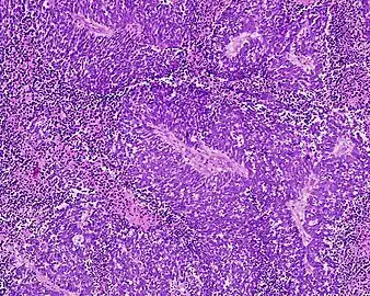 Anaplastic (microcellular, oat cell) carcinoma from the lung (histopathology)