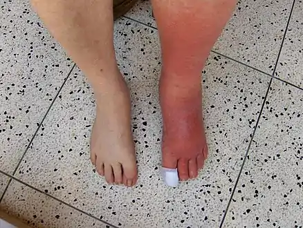 Example of cellulitis showing 3+ edema of left leg