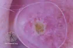 Chondrodermatitis nodularis helicis dermoscopy