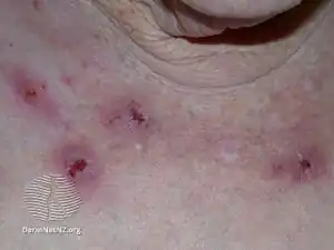 Compulsive skin picking