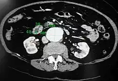 A transverse contrast enhanced CT scan demonstrating an abdominal aortic aneurysm of 4.8 by 3.8 cm