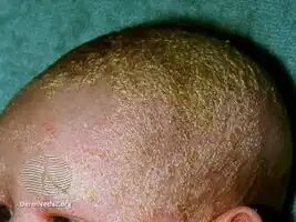 Cradle cap