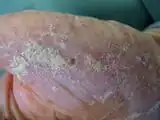 Crusted scabies