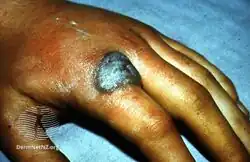 Cutaneous tuberculosis