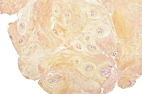 Micrograph of a fragment of a resected degenerative vertebral disc, showing degenerative fibrocartilage and clusters of chondrocytes.