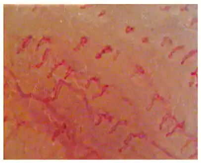 Capillaroscopic evaluation in Burning mouth syndrome
