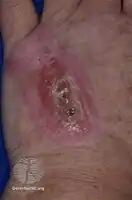 Factitious dermatitis