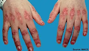 Gottron's papules on finger joints