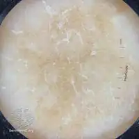 Magnified view: fine scale over dark area in pityriasis versicolor