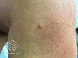Desmoplastic melanoma