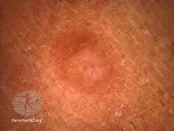 Desmoplastic melanoma