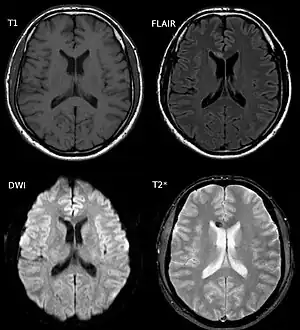 Diffuse axonal injury after a motorcycle accident. MRI after 3 days: on T1-weighted images the injury is barely visible. On the FLAIR, DWI and T2*-weighted images a small bleed is identifiable.