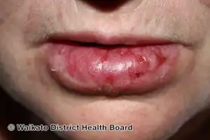 Discoid lupus erythematosus