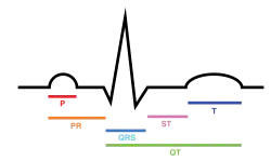Normal ECG tracing for a single contraction of the heart.