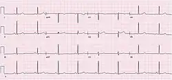 Electrocardiogram (ECG) of a 64-year-old female with sinus bradycardia. Heart rate 49 bpm.