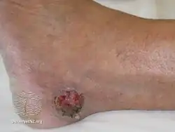 Eccrine porocarcinoma