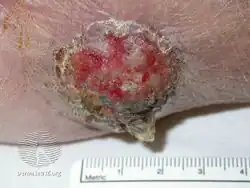 Eccrine porocarcinoma