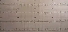 An ECG showing sinus tachycardia and electrical alternans in a person with a pericardial effusion.