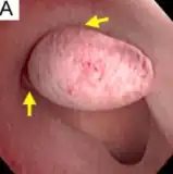 Pedunculated endometrial polyp